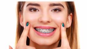 color, braces